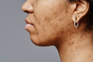 Microneedling Gone Wrong