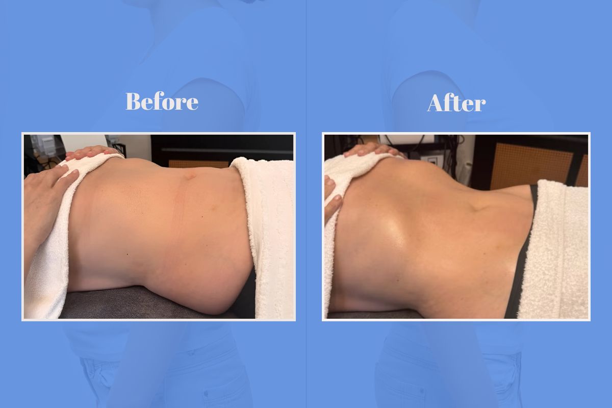 Zoe Ball Before and after